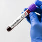 hantavirus 85x85